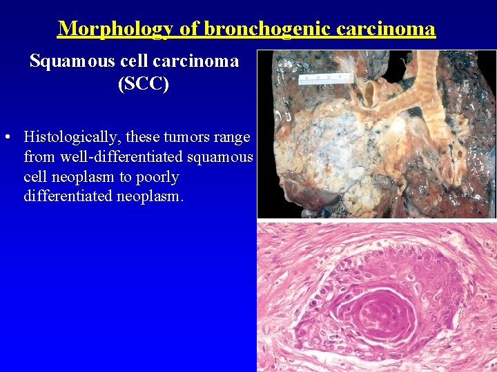 Morphology of bronchogenic carcinoma Squamous cell carcinoma (SCC) • Histologically, these tumors range from