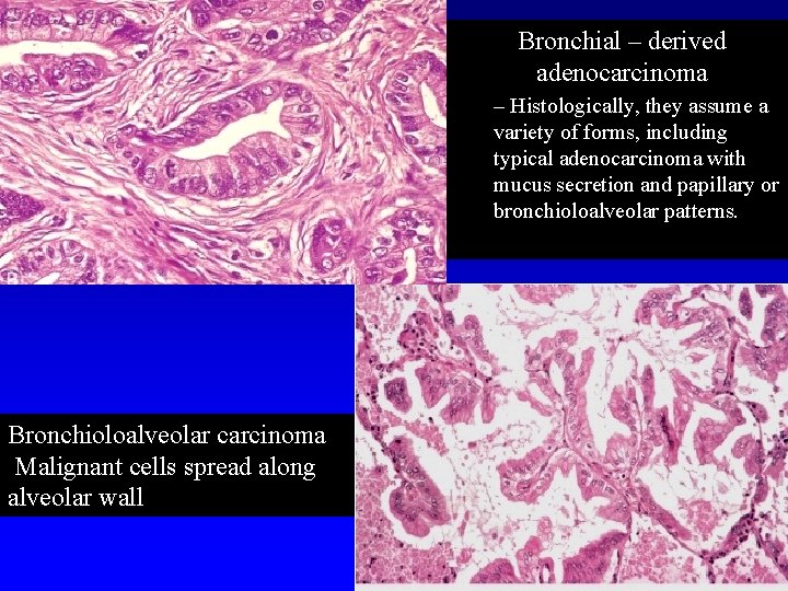 Bronchial – derived adenocarcinoma – Histologically, they assume a variety of forms, including typical