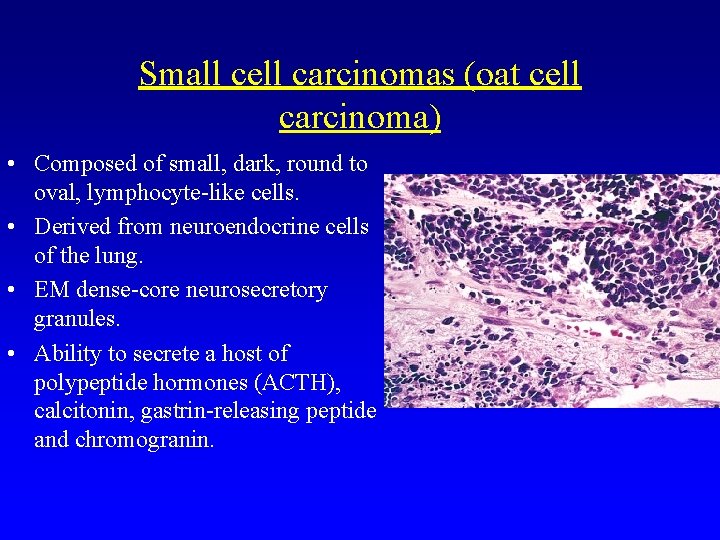 Small cell carcinomas (oat cell carcinoma) • Composed of small, dark, round to oval,