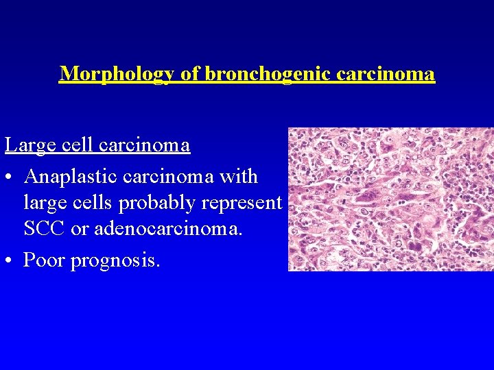 Morphology of bronchogenic carcinoma Large cell carcinoma • Anaplastic carcinoma with large cells probably