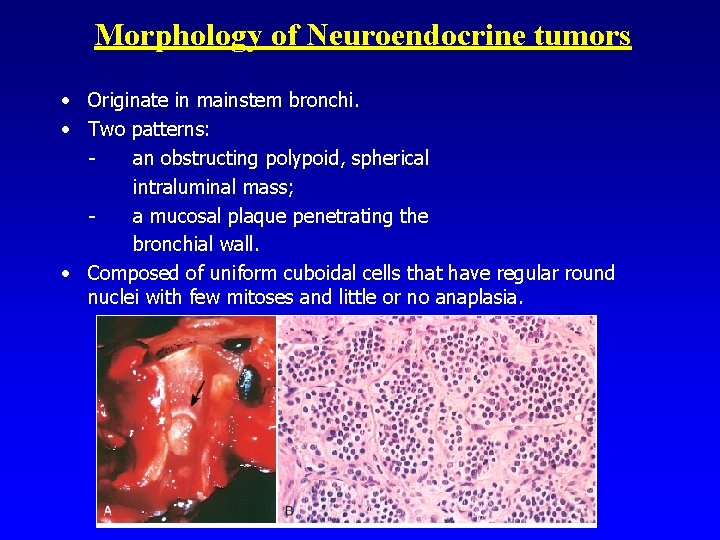 Morphology of Neuroendocrine tumors • Originate in mainstem bronchi. • Two patterns: an obstructing