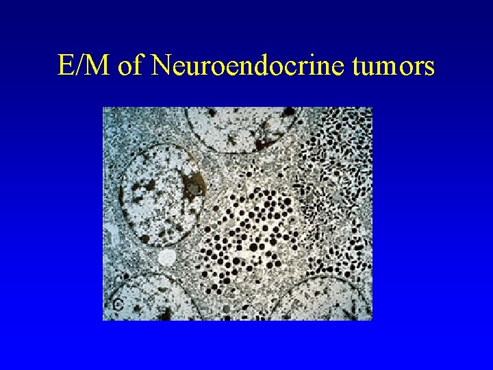 E/M of Neuroendocrine tumors 