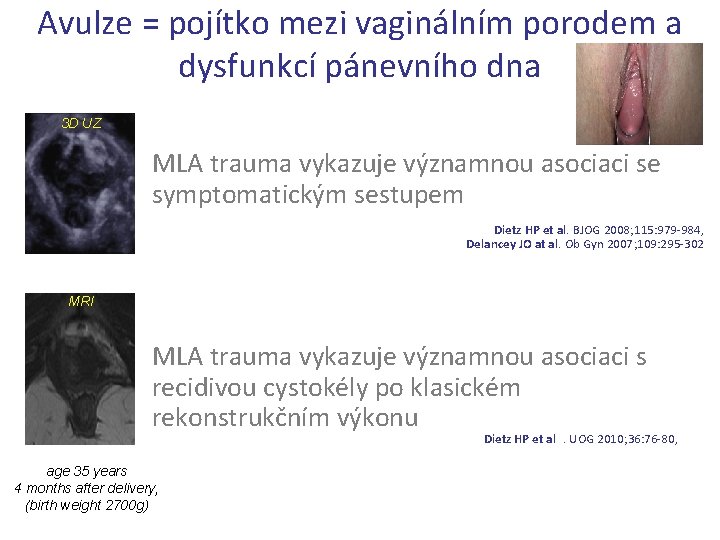 Avulze = pojítko mezi vaginálním porodem a dysfunkcí pánevního dna 3 D UZ MLA