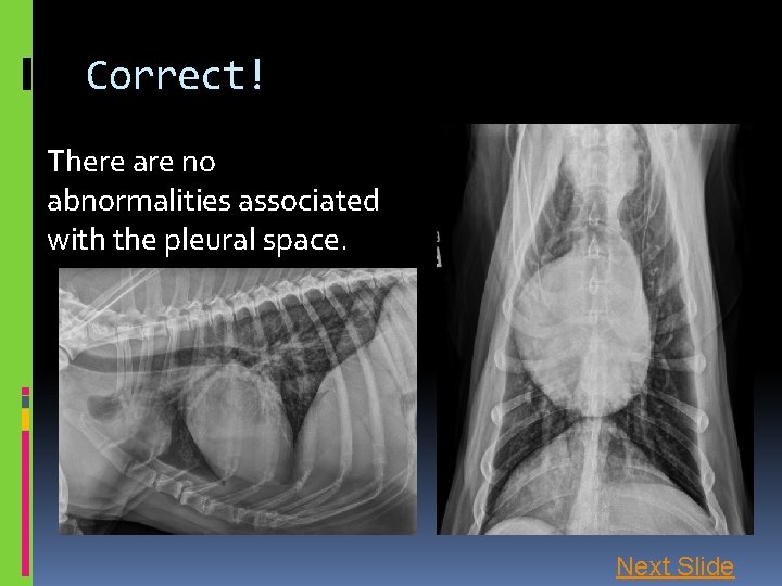 Correct! There are no abnormalities associated with the pleural space. Next Slide 