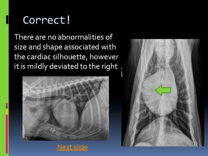 Correct! There are no abnormalities of size and shape associated with the cardiac silhouette,