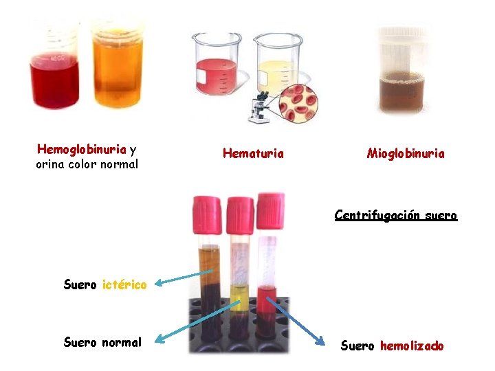 Hemoglobinuria y orina color normal Hematuria Mioglobinuria Centrifugación suero Suero ictérico Suero normal Suero