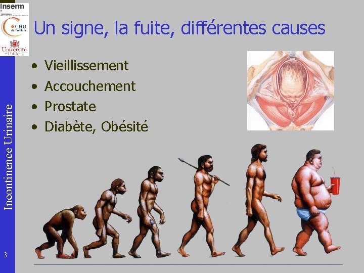 Incontinence Urinaire Un signe, la fuite, différentes causes 3 • • Vieillissement Accouchement Prostate