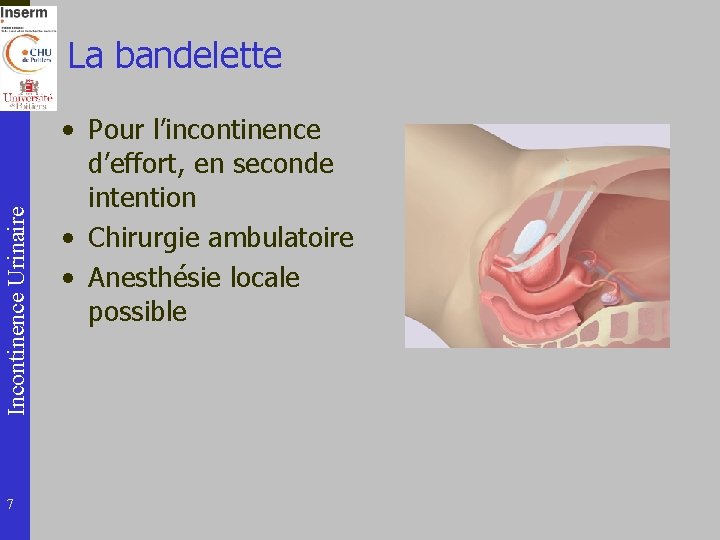 Incontinence Urinaire La bandelette 7 • Pour l’incontinence d’effort, en seconde intention • Chirurgie