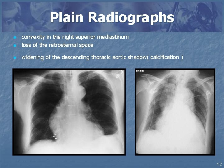 Plain Radiographs n convexity in the right superior mediastinum loss of the retrosternal space