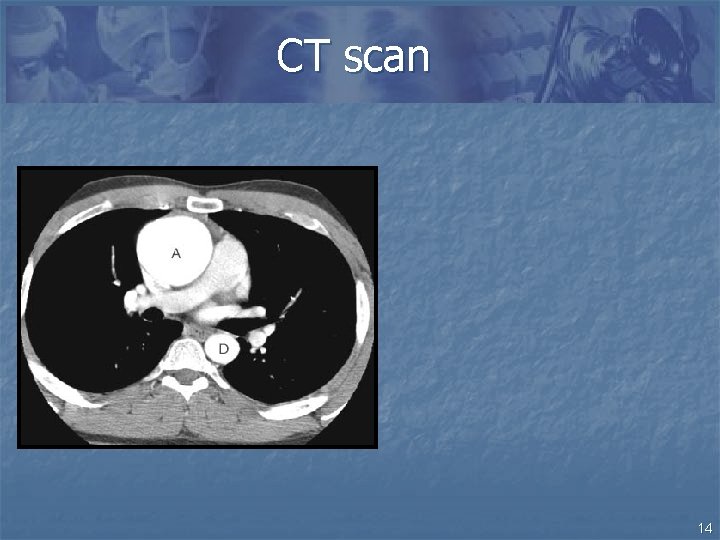 CT scan 14 