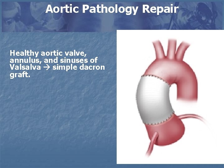 Aortic Pathology Repair Healthy aortic valve, annulus, and sinuses of Valsalva simple dacron graft.