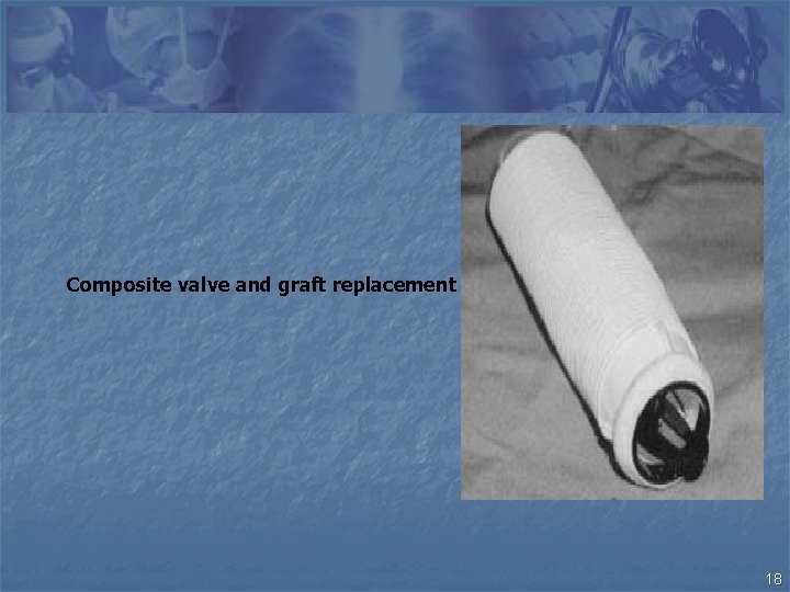 Composite valve and graft replacement 18 