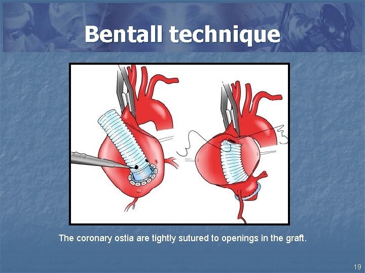 Bentall technique The coronary ostia are tightly sutured to openings in the graft. 19
