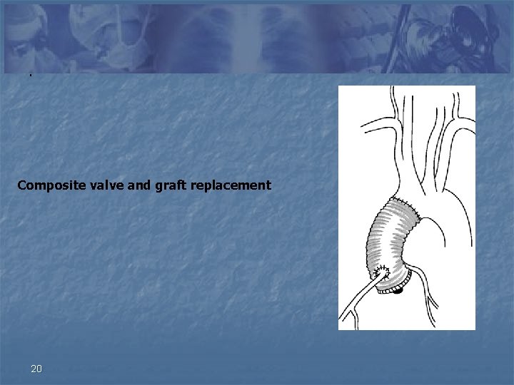 . Composite valve and graft replacement 20 