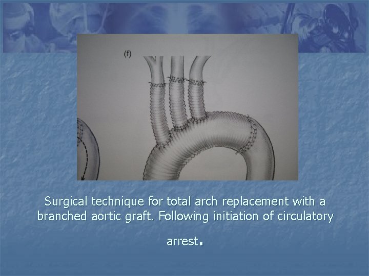 Surgical technique for total arch replacement with a branched aortic graft. Following initiation of