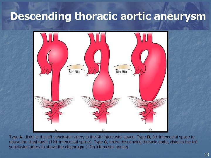 Descending thoracic aortic aneurysm Type A, distal to the left subclavian artery to the