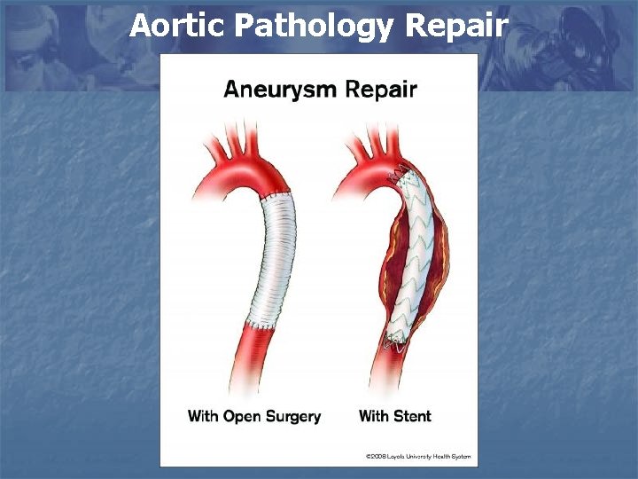 Aortic Pathology Repair 