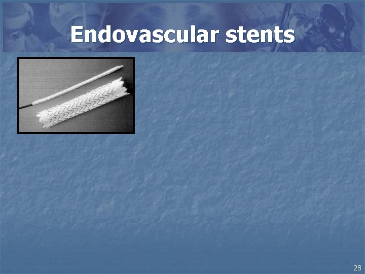 Endovascular stents 28 