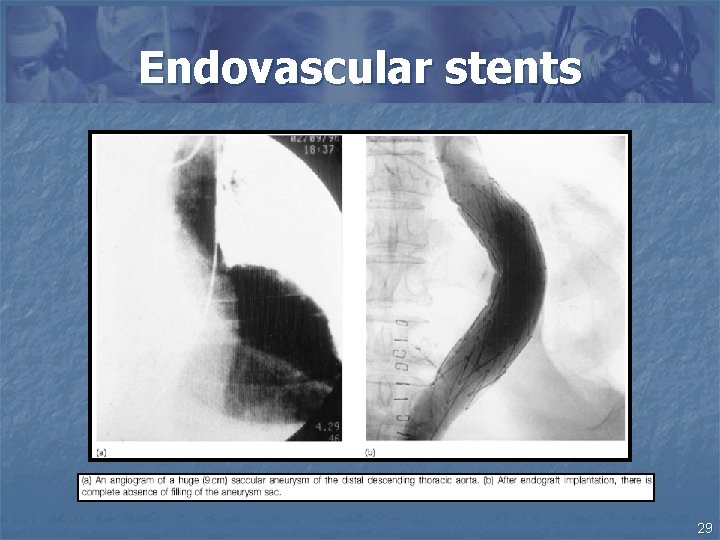 Endovascular stents 29 