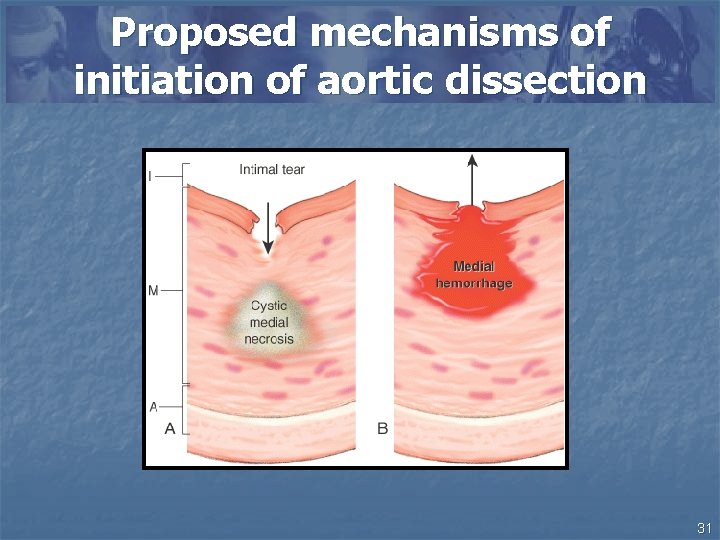 Proposed mechanisms of initiation of aortic dissection 31 
