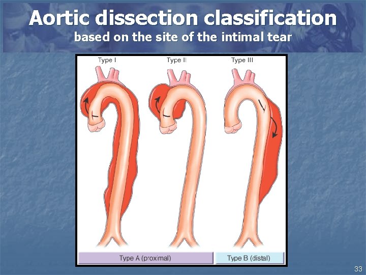 Aortic dissection classification based on the site of the intimal tear 33 