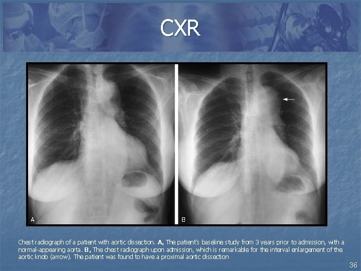 CXR Chest radiograph of a patient with aortic dissection. A, The patient's baseline study