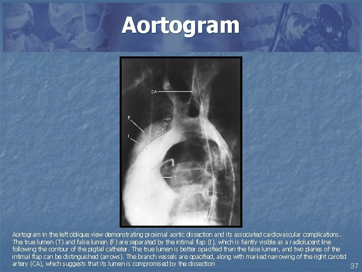 Aortogram in the left oblique view demonstrating proximal aortic dissection and its associated cardiovascular