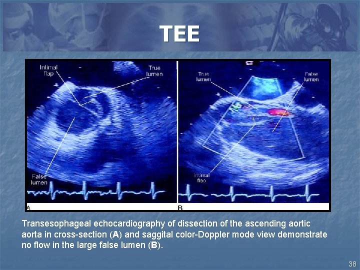 TEE Transesophageal echocardiography of dissection of the ascending aortic aorta in cross-section (A) and