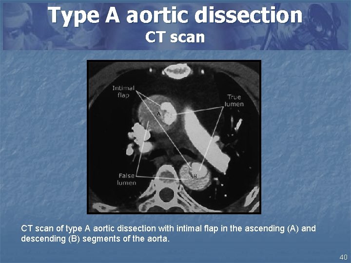 Type A aortic dissection CT scan of type A aortic dissection with intimal flap