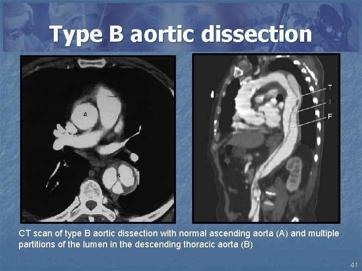 Type B aortic dissection CT scan of type B aortic dissection with normal ascending