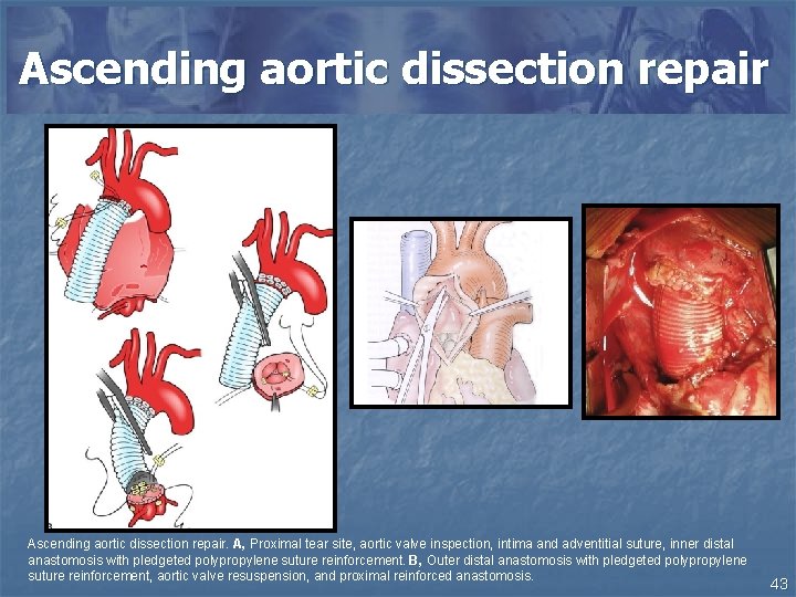Ascending aortic dissection repair. A, Proximal tear site, aortic valve inspection, intima and adventitial