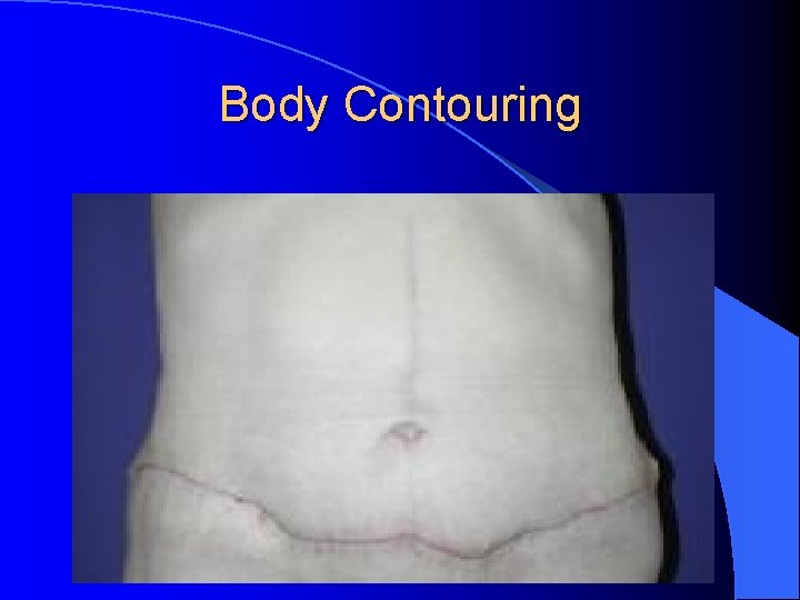 Body Contouring Body Contouring