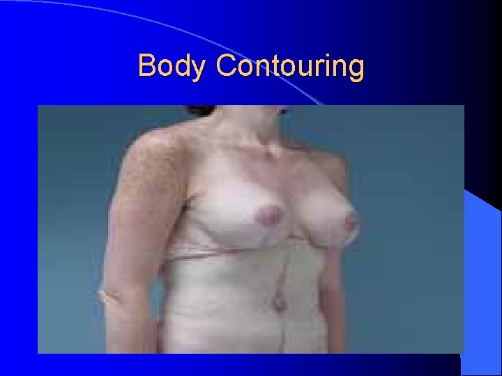 Body Contouring Body Contouring