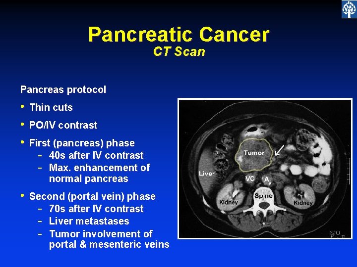 Pancreatic Cancer CT Scan Pancreas protocol • • • Thin cuts • Second (portal