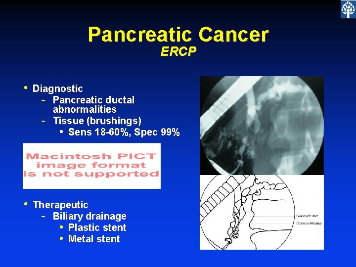 Pancreatic Cancer ERCP • Diagnostic - Pancreatic ductal abnormalities - Tissue (brushings) • Sens