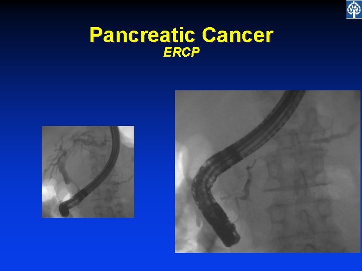 Pancreatic Cancer ERCP 