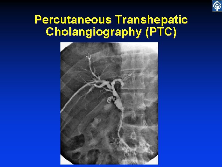 Percutaneous Transhepatic Cholangiography (PTC) 