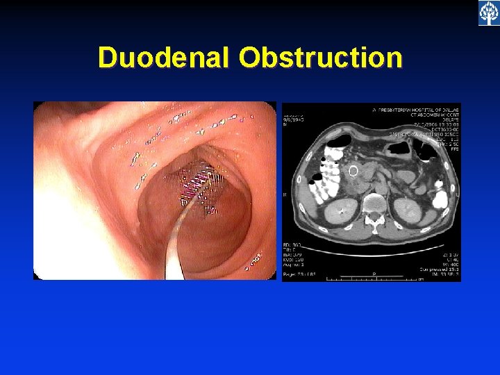 Duodenal Obstruction 