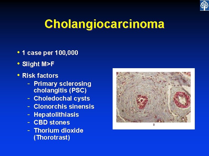 Cholangiocarcinoma • 1 case per 100, 000 • Slight M>F • Risk factors -