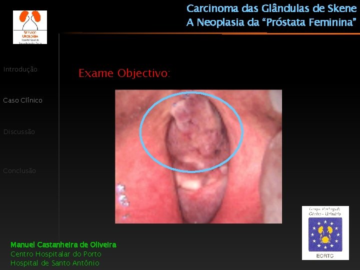 Carcinoma das Glândulas de Skene A Neoplasia da “Próstata Feminina” Introdução Exame Objectivo: Caso