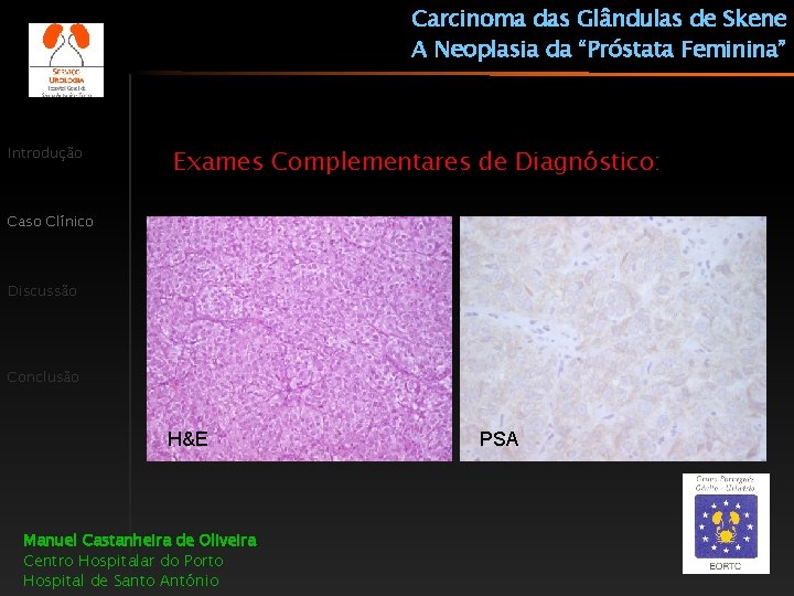 Carcinoma das Glândulas de Skene A Neoplasia da “Próstata Feminina” Introdução Exames Complementares de