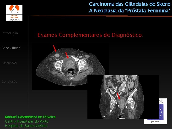 Carcinoma das Glândulas de Skene A Neoplasia da “Próstata Feminina” Introdução Exames Complementares de