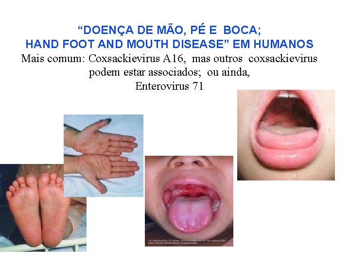 “DOENÇA DE MÃO, PÉ E BOCA; HAND FOOT AND MOUTH DISEASE” EM HUMANOS Mais