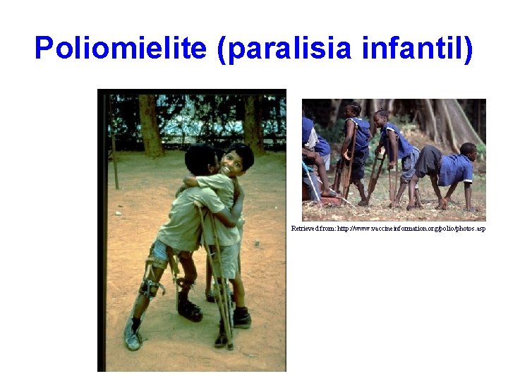 Poliomielite (paralisia infantil) Retrieved from: http: //www. vaccineinformation. org/polio/photos. asp 