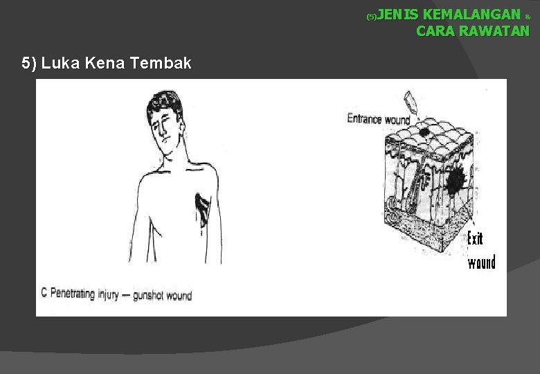 JENIS KEMALANGAN & CARA RAWATAN (5) 5) Luka Kena Tembak 