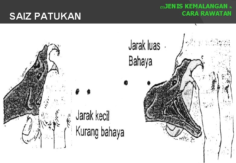 JENIS KEMALANGAN & CARA RAWATAN (5) SAIZ PATUKAN 