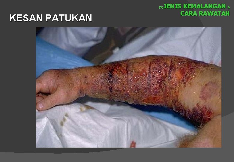 JENIS KEMALANGAN & CARA RAWATAN (5) KESAN PATUKAN 