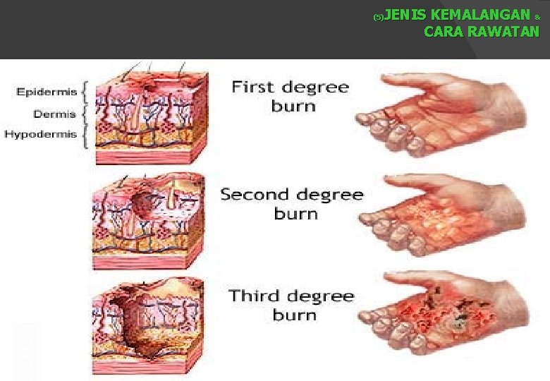 JENIS KEMALANGAN & CARA RAWATAN (5) 