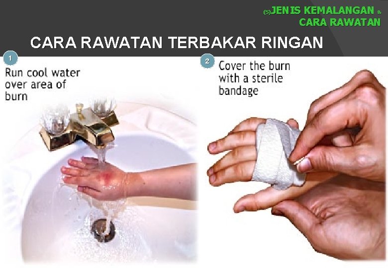 JENIS KEMALANGAN & CARA RAWATAN (5) CARA RAWATAN TERBAKAR RINGAN 1 2 
