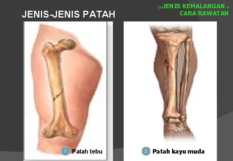JENIS KEMALANGAN & CARA RAWATAN (5) JENIS-JENIS PATAH 1 Patah tebu 2 Patah kayu